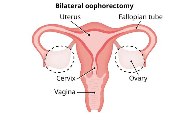 oophorectomy