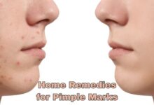 Home Remedies for Pimple Marks