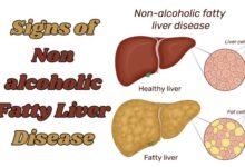 Signs of Non alcoholic Fatty Liver Disease