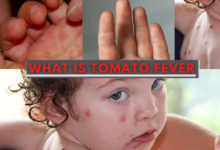 What is Tomato Fever